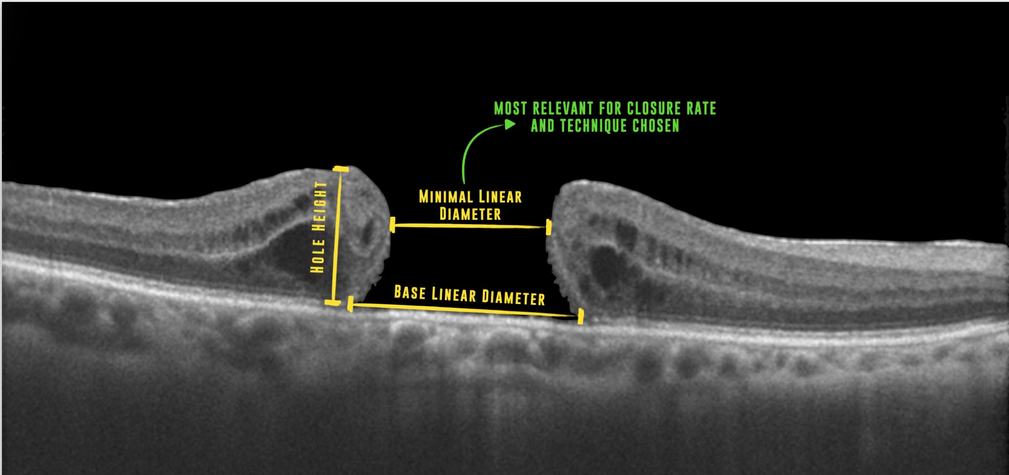 OCT measurement guide for minimum linear diameter, hole height and base diameter